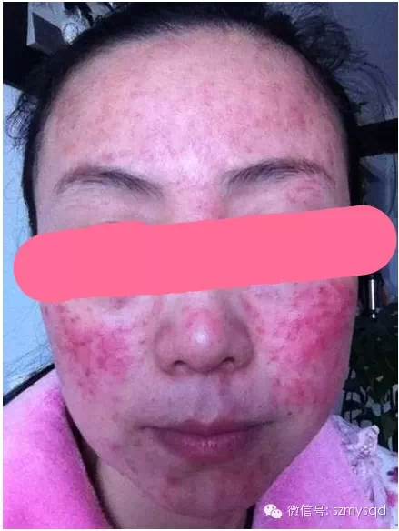激素脸如果发生在你身上,你会恐惧吗?